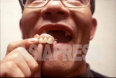 安全部での取り調べ過程でひどく殴られ前歯を8本失ったAさん。闇商売にかかわった容疑で90年代初めに逮捕されたという。 （1998年ソウルにて　石丸次郎撮影）