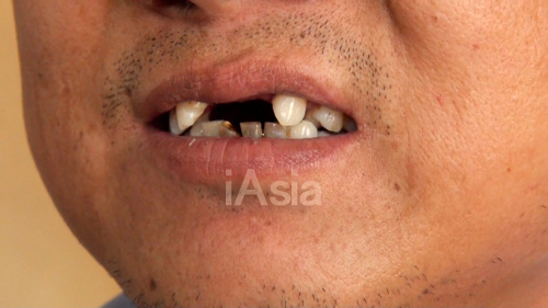 歯が抜けた訴える打拉亥村の男性（2013年5月22日）