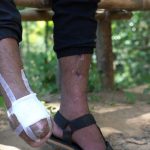 ミャンマー内戦4年　解放区潜入1ヶ月　タイ国境・カレンニー州からの報告（5）密林の療養施設　「足を失い、死のうと思った」